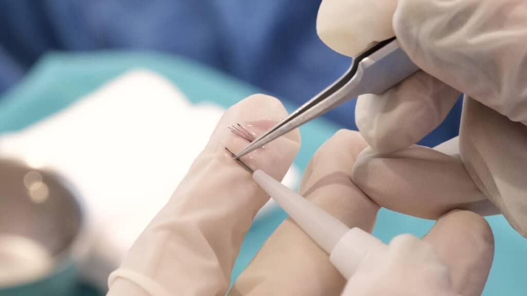 การเตรียมกราฟต์ผมสำหรับการปลูกผม DHI