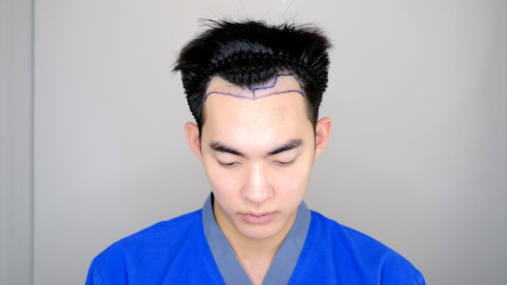 ผู้ชายเตรียมตัวเข้ารับการปลูกผม DHI แบบไม่ต้องโกนผม