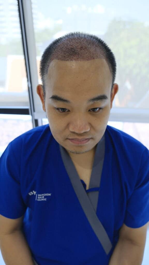 คนไข้หลังเข้ารับการปลูกผมแบบ DHI Micrograft โดยไม่ต้องโกนผม