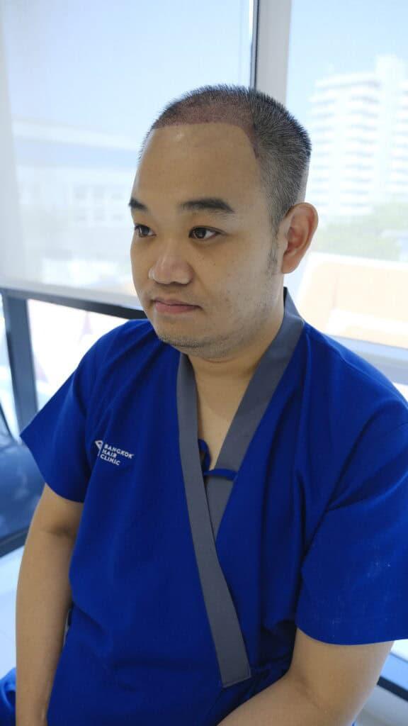 คนไข้หลังเข้ารับการปลูกผมแบบ DHI Micrograft โดยไม่ต้องโกนผม