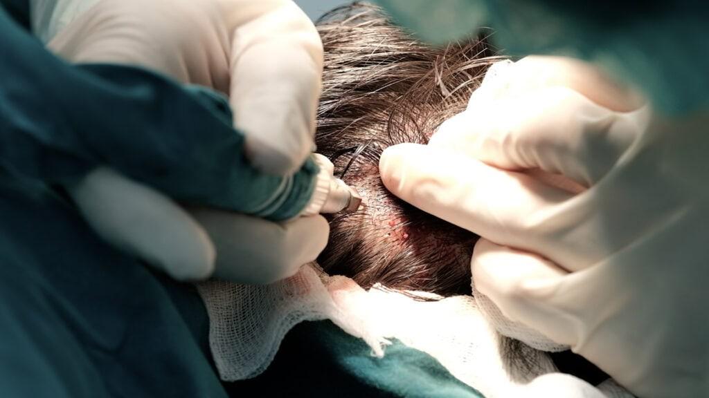 การเก็บรากผมด้วยใบมีด Spphire สำหรับการปลูกผม DHI แบบไม่ต้องโกน