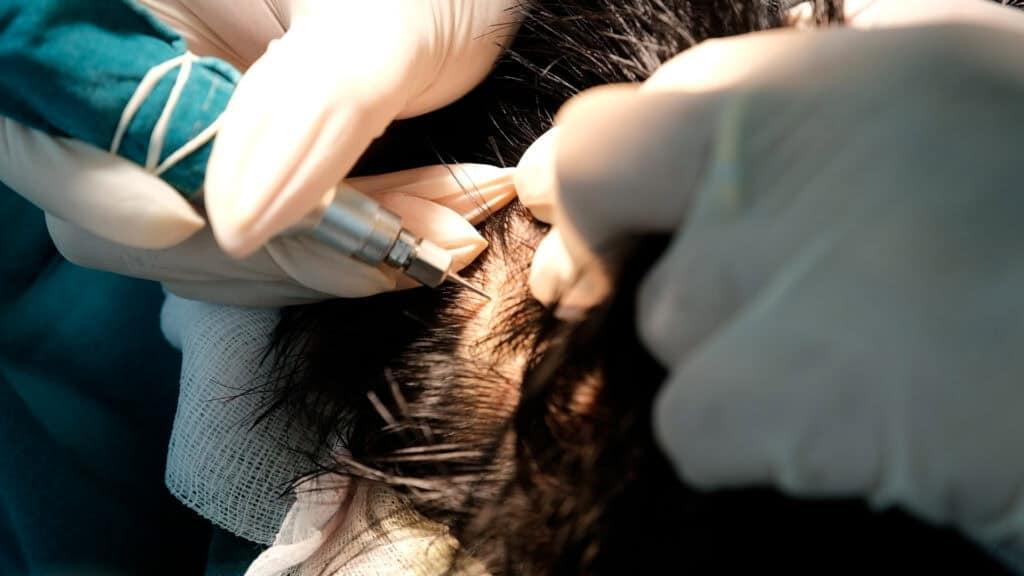 การใช้อุปกรณ์พิเศษเก็บกราฟต์ผมเพื่อนำมาปลูกผมแบบ DHI Micrograft