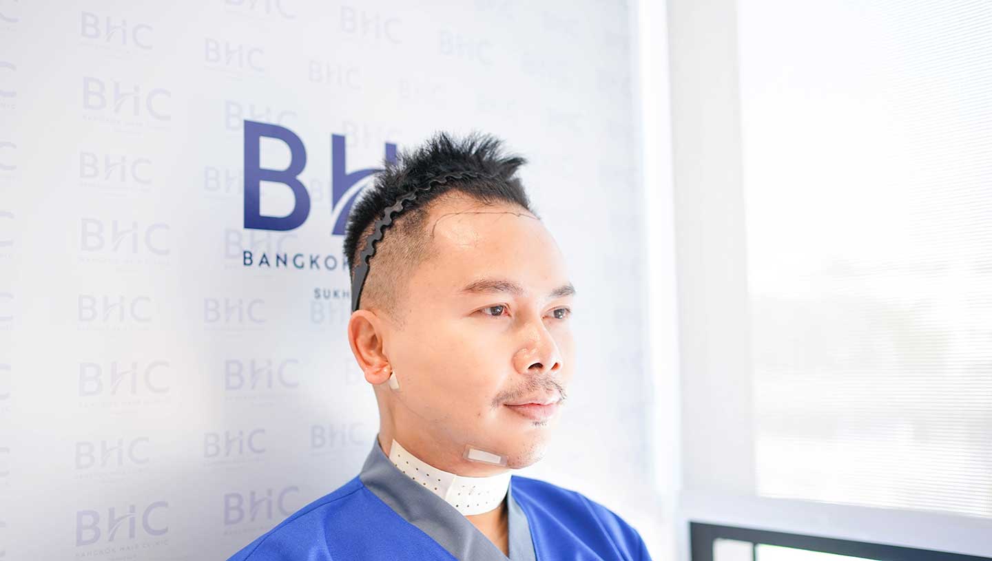 Hair Transplant Archives Bangkok Hair Clinic