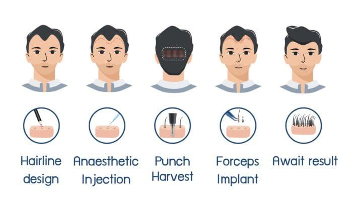DHI micrograft hair transplant process guide