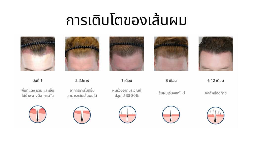 ไทม์ไลน์การเติบโตของเส้นผมหลังการปลูกผมด้วยเทคนิค Long Hair DHI