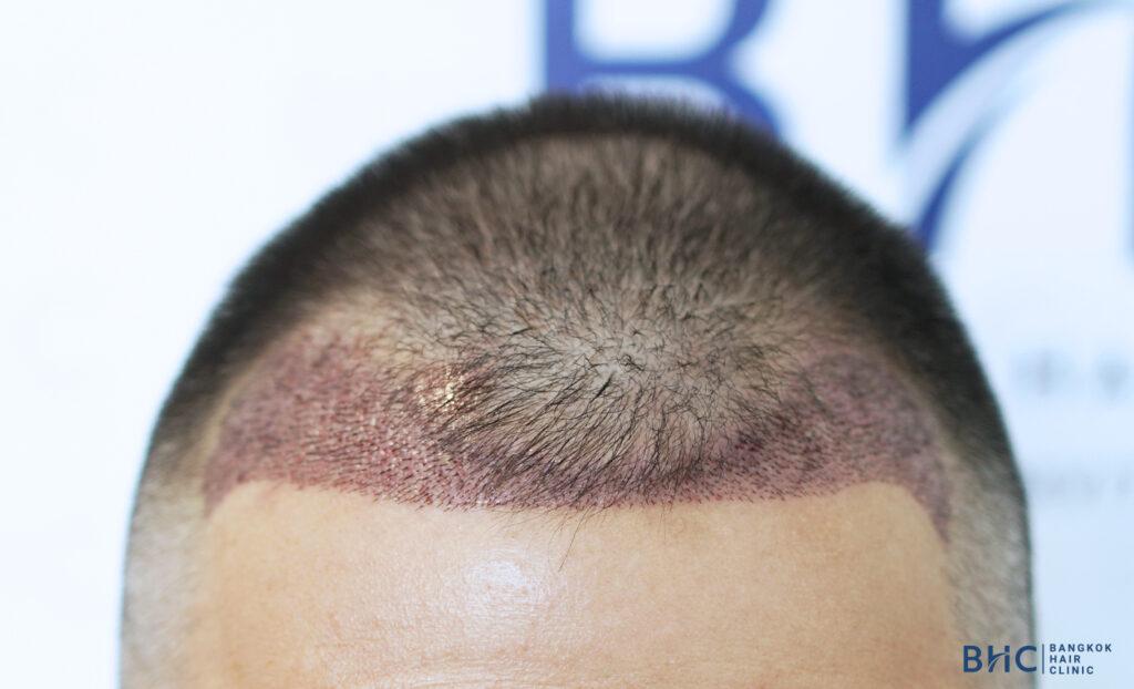 After 20 Days of Hair Transplant: What to Expect?