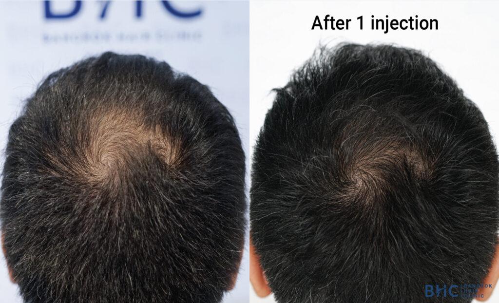Before and after photos of a stem cell therapy patient for hair loss