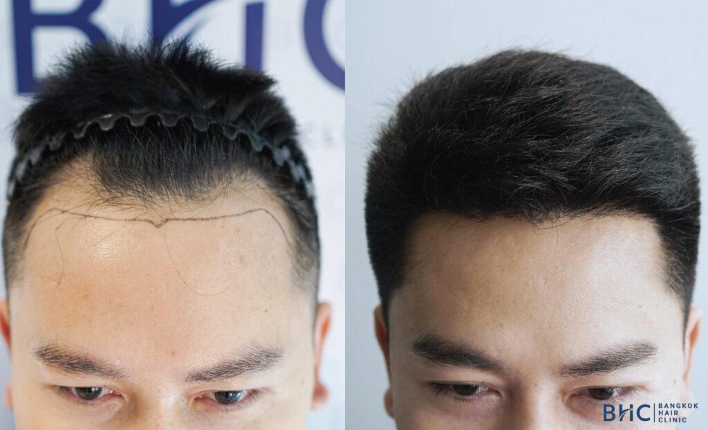 ผลลัพธ์หลังปลูกผมด้วยเทคนิค FUE with Implanter (DHI) เป็นเวลา 9 เดือน