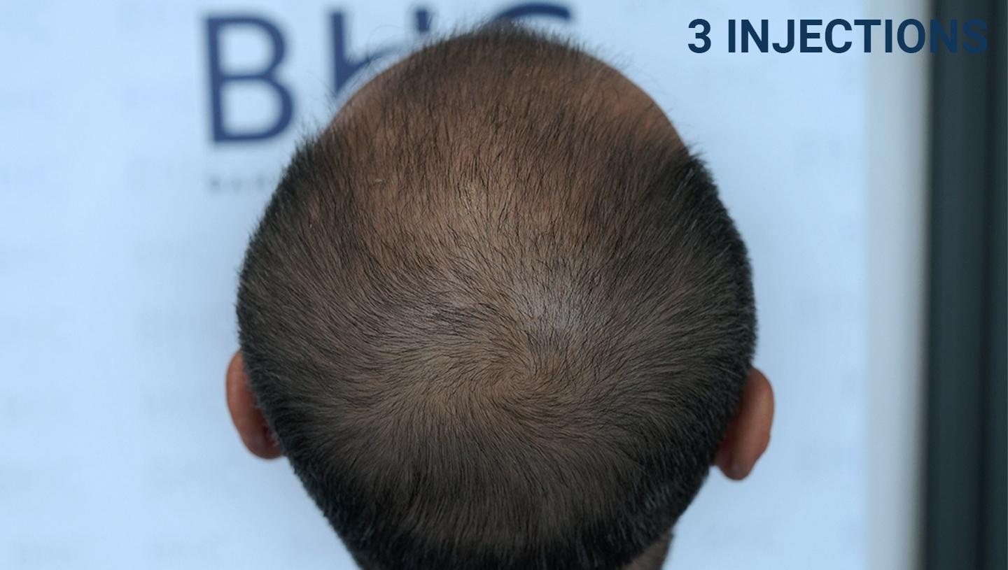 Result Bangkok Hair Clinic Bangkok Hair Clinic