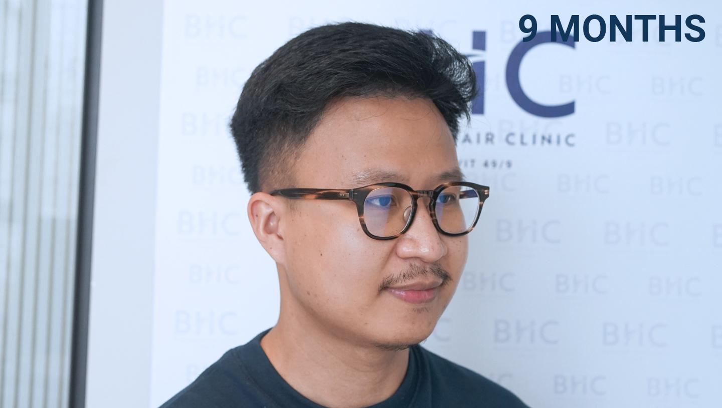 Result Bangkok Hair Clinic Bangkok Hair Clinic