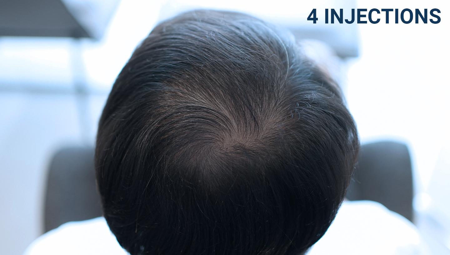 Result Bangkok Hair Clinic Bangkok Hair Clinic