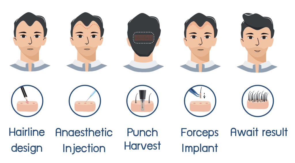 Steps in the Non-Shaven FUE Hair Transplant Technique