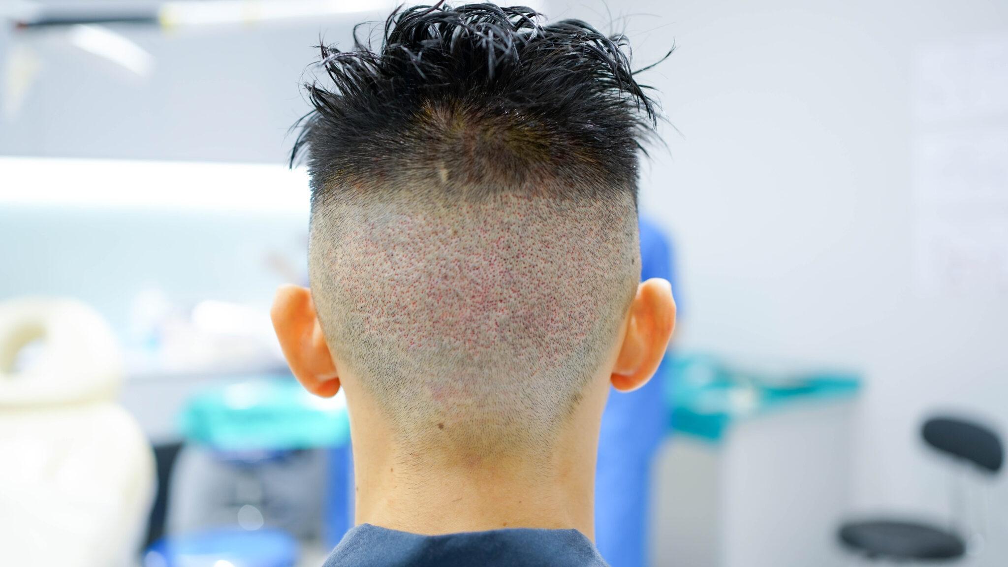 FUE Shaven Bangkok Hair Clinic