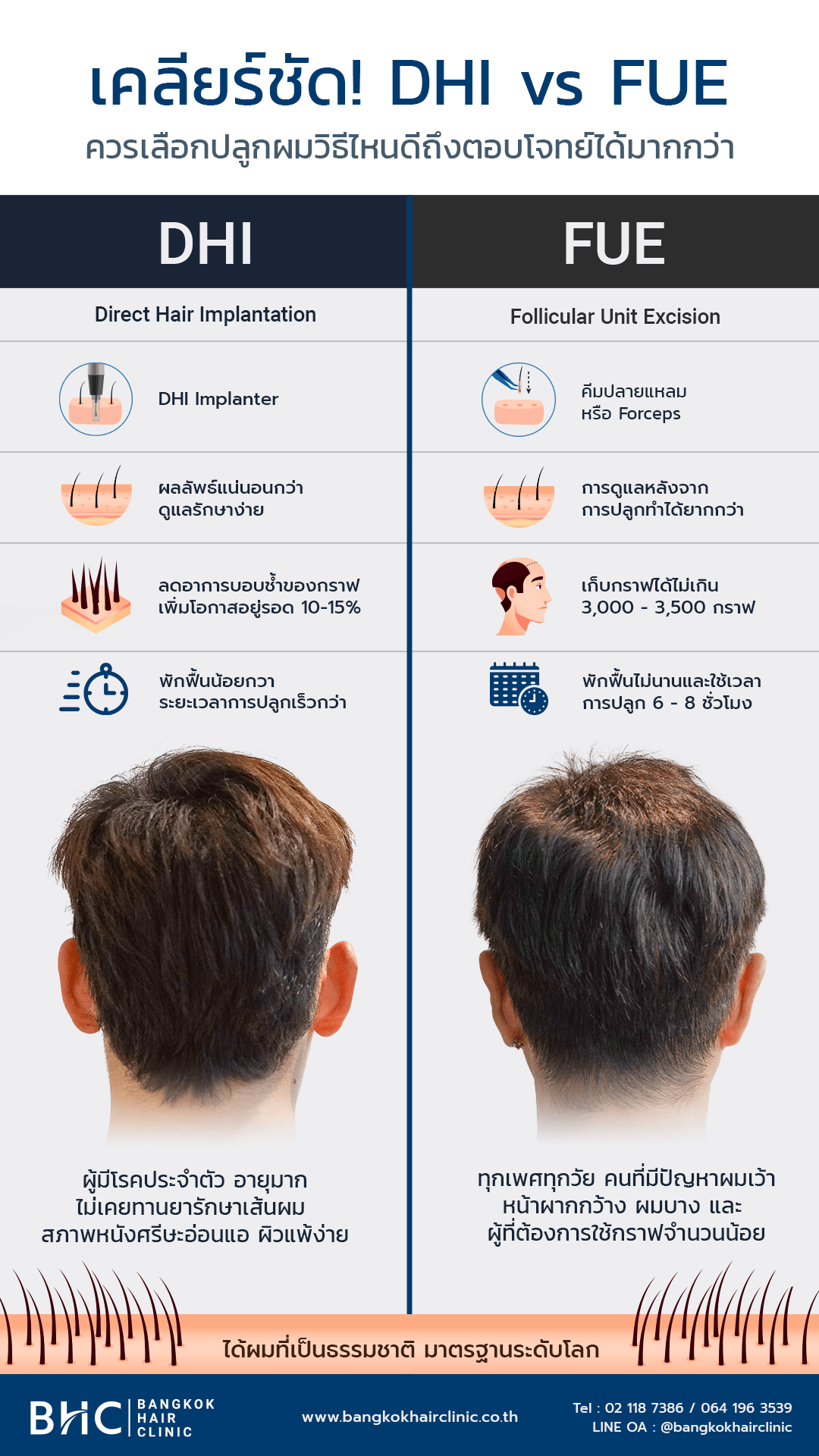 เคลียร์ชัด! DHI vs FUE ควรเลือกปลูกผมวิธีไหนดีถึงตอบโจทย์ได้มากกว่า