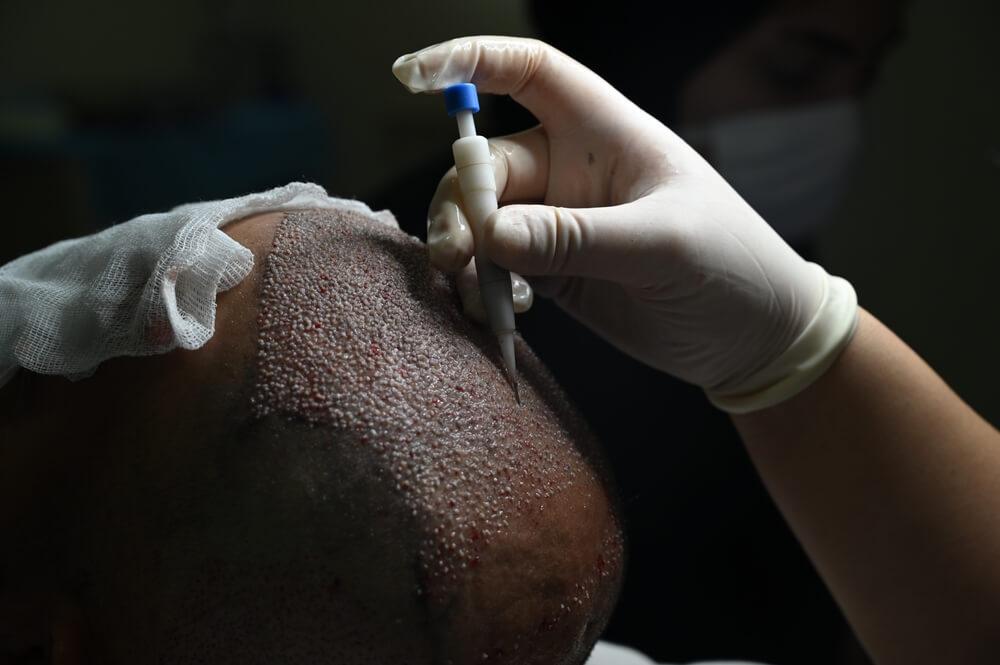 Clear Comparison: DHI Vs. FUE Hair Transplants