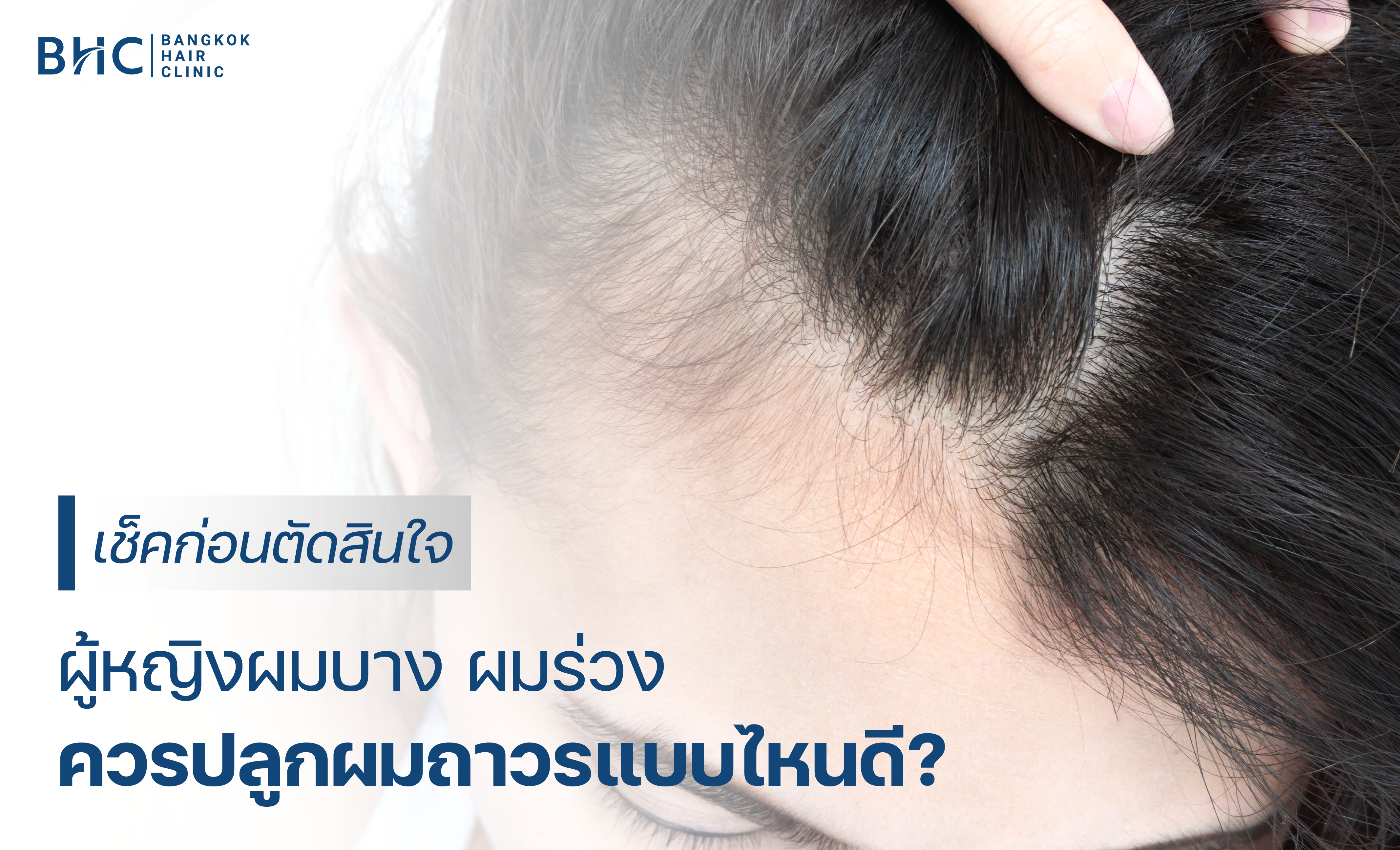 เช็กก่อนตัดสินใจ! ผู้หญิงผมบาง ผมร่วงควรปลูกผมถาวรแบบไหนดี?