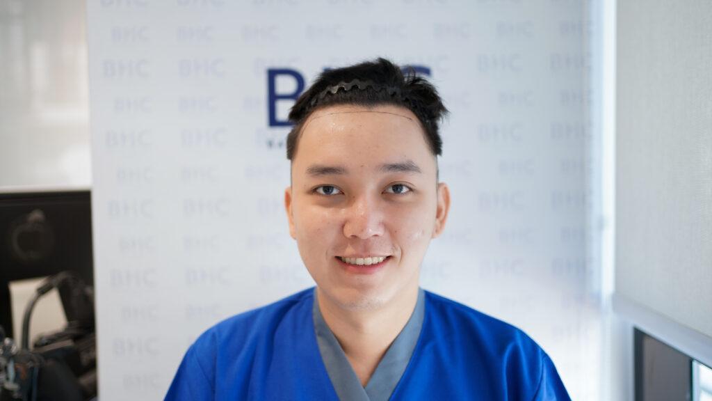 ปลูกผมถาวรแบบ FUE ก่อน - Bangkok Hair Clinic