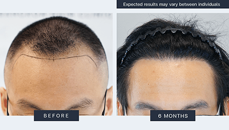 Result - Bangkok Hair Clinic Result - Bangkok Hair Clinic