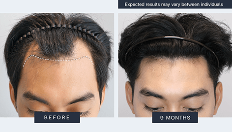Result - Bangkok Hair Clinic