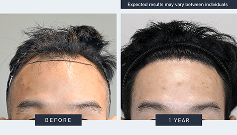 Result - Bangkok Hair Clinic Result - Bangkok Hair Clinic