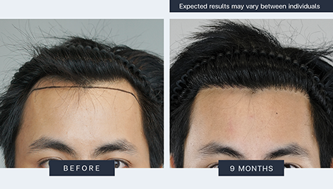 Result - Bangkok Hair Clinic Result - Bangkok Hair Clinic