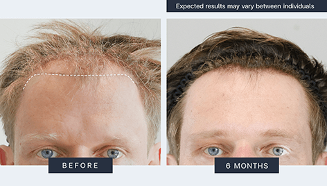 The best permanent hair transplant clinic in Thailand - Bangkok Hair Clinic The best permanent hair transplant clinic in Thailand - Bangkok Hair Clinic