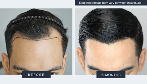 Result - Bangkok Hair Clinic