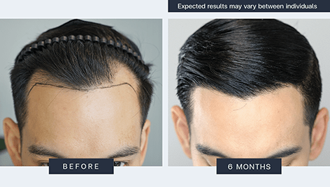 Result - Bangkok Hair Clinic Result - Bangkok Hair Clinic