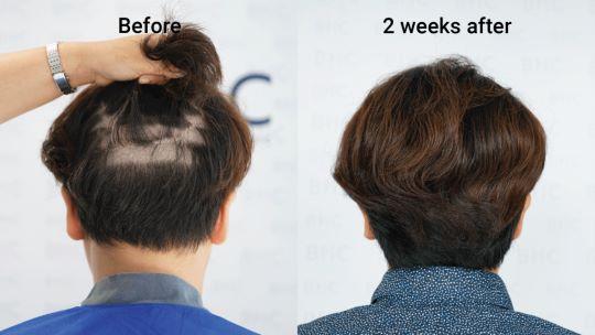 บริเวณหลังศีรษะหลังทำการปลูกผมเทคนิค FUE เป็นเวลา 2 สัปดาห์
