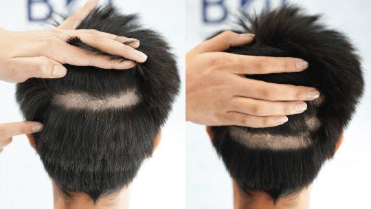 ภาพพื้นที่ที่จะนำกราฟออกมา ในขั้นตอนของเทคนิคปลูกผมไร้รอยแผลเป็น