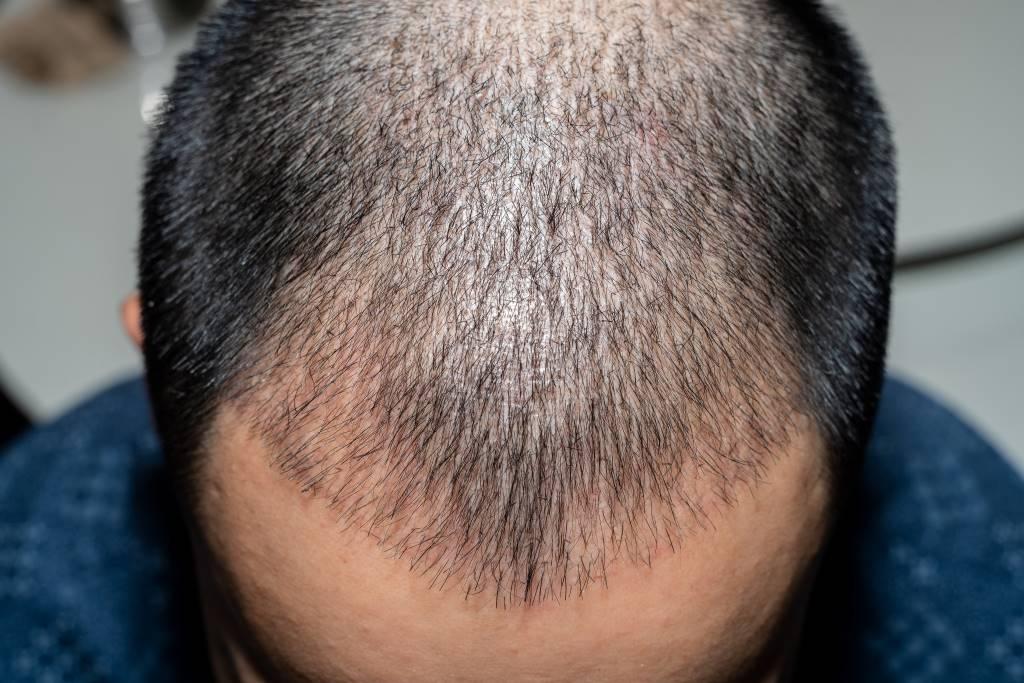 Many types of hair loss can be corrected surgically.