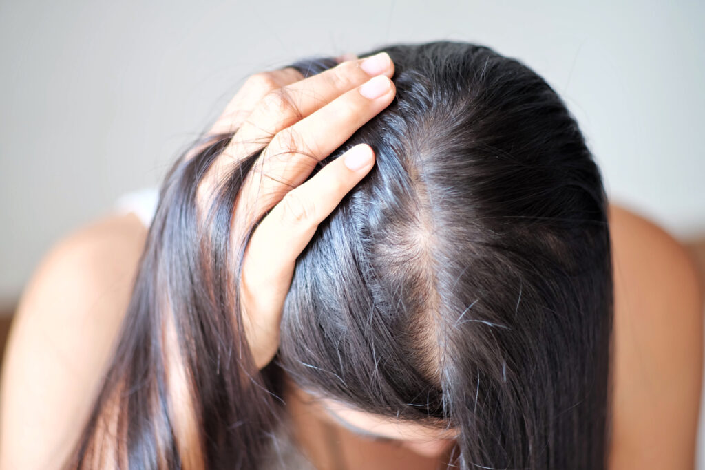 Female showing her scalp with thinning hair caused by hair loss in the middle of her head.