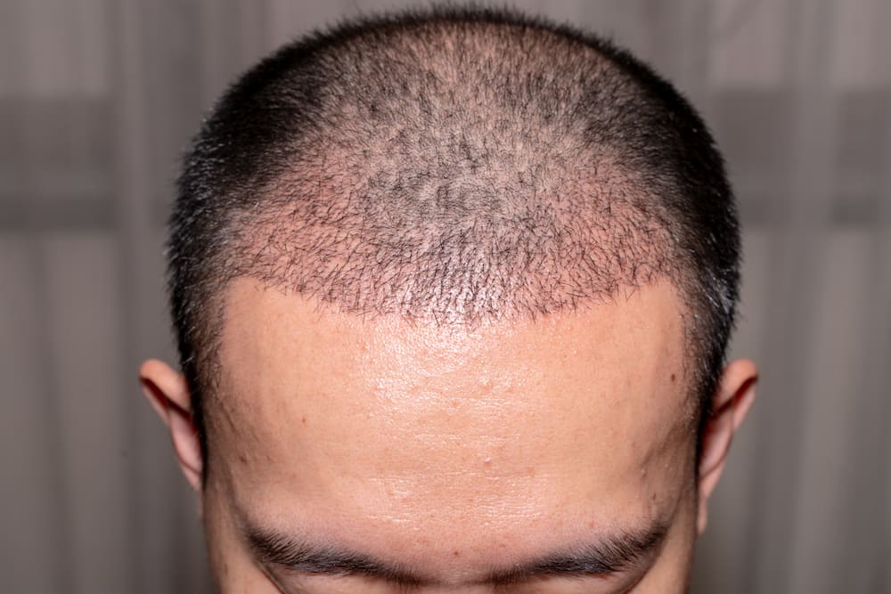 FUE hair transplants maintain a natural-looking hairline.