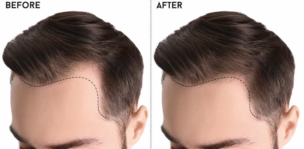 Natural hair regrowth treatment