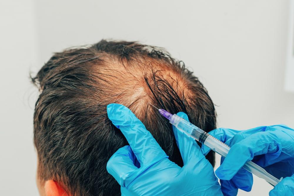 Male patient getting non-invasive hair loss treatment