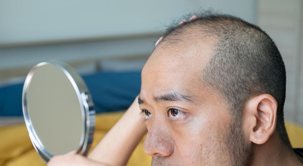Nearly 50% of men in their 40s have male pattern baldness