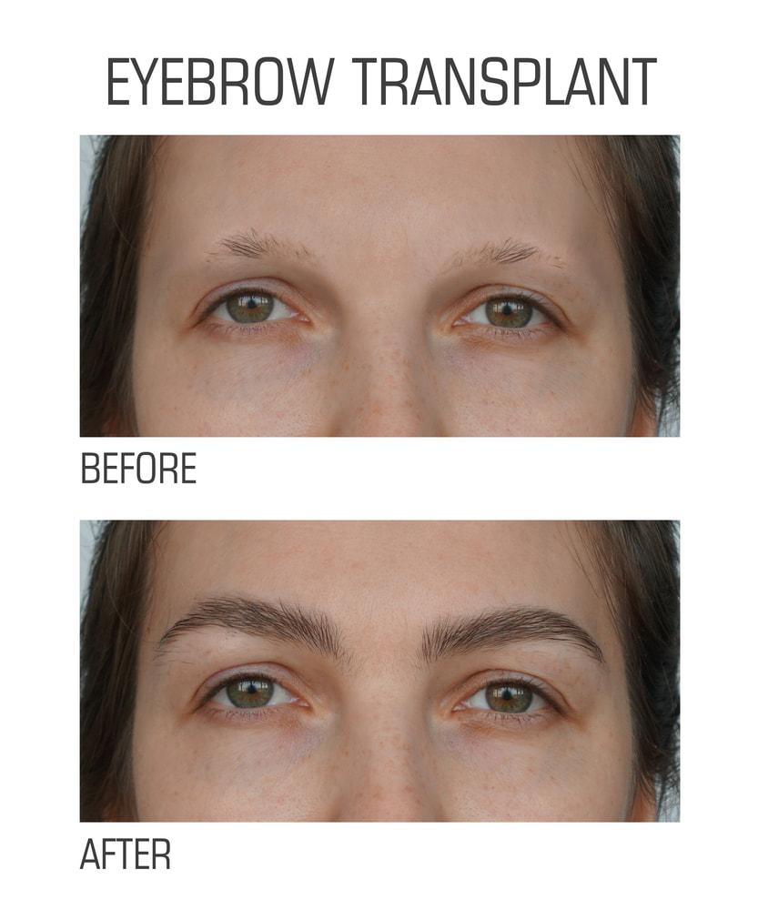 Eyebrow transplant before and after