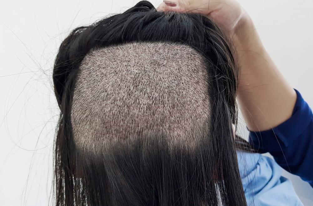 FUE hair transplant donor areas are easily hidden