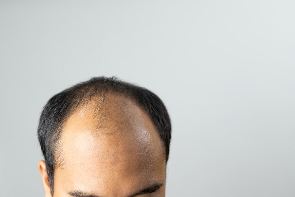 New techniques are making hair transplants easier