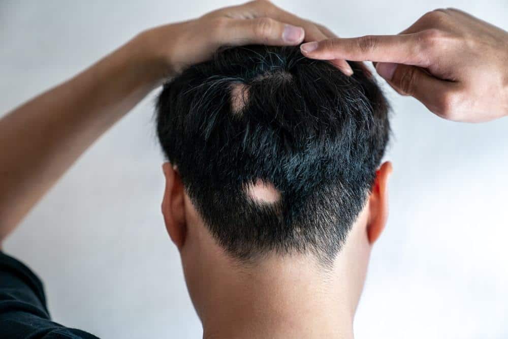 Are Hair Transplants a Remedy for Trichotillomania Damage?