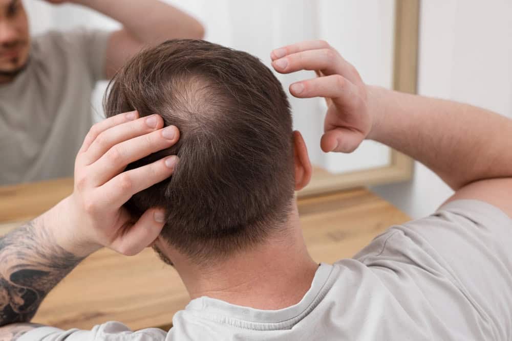 A man considers a hair transplant 