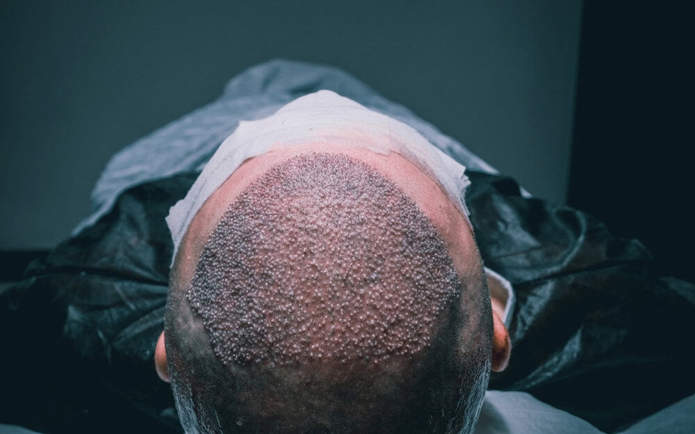 Is Minoxidil Needed Before and After a Hair Transplant?