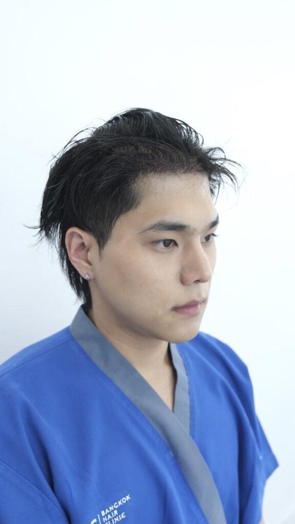 Side view after long hair DHI transplant surgery