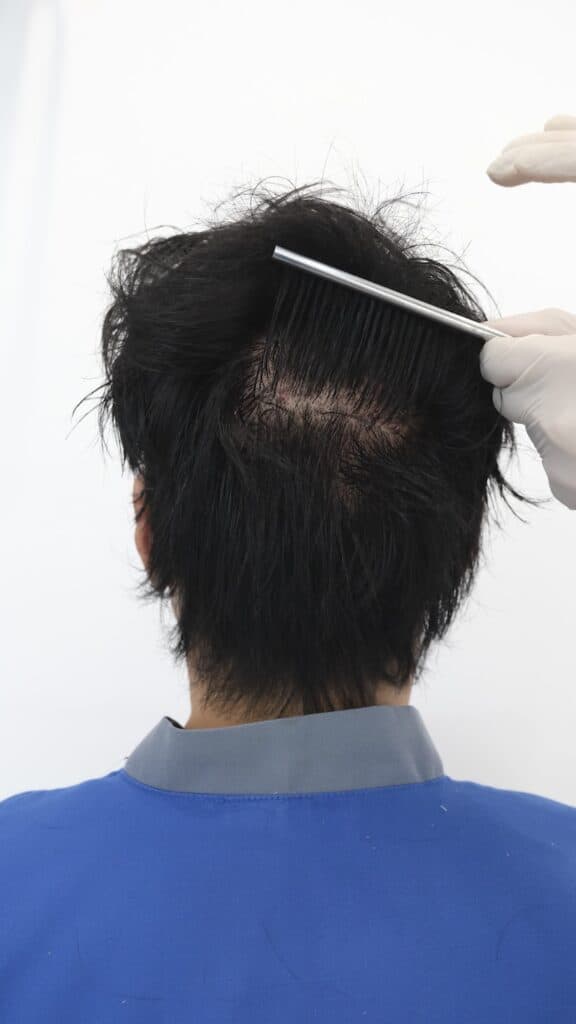 Donor area assessment for long hair DHI in Thailand