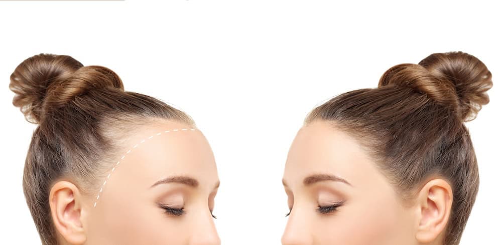 A woman’s long hair transplant before and after images of