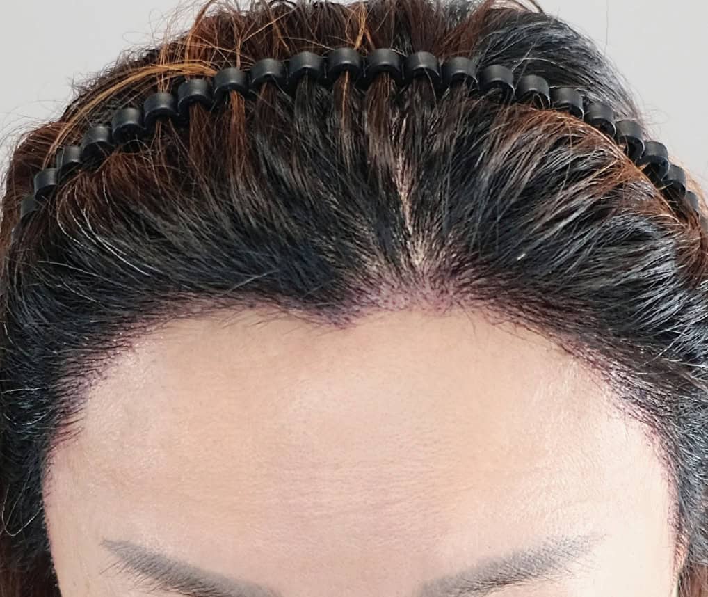 ภาพหลังเข้ารับการปลูกผมด้วยเทคนิค Long Hair DHI