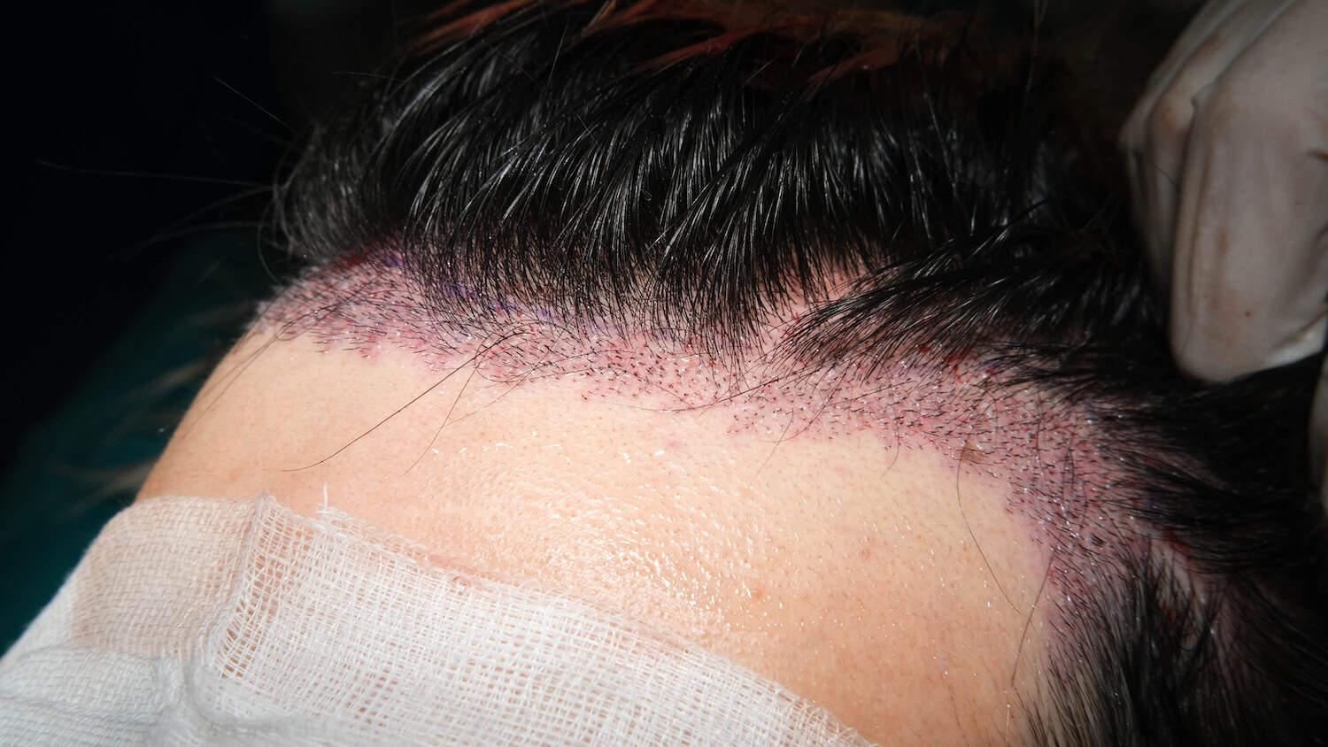 Hair transplant with DHI micrograft along hairline