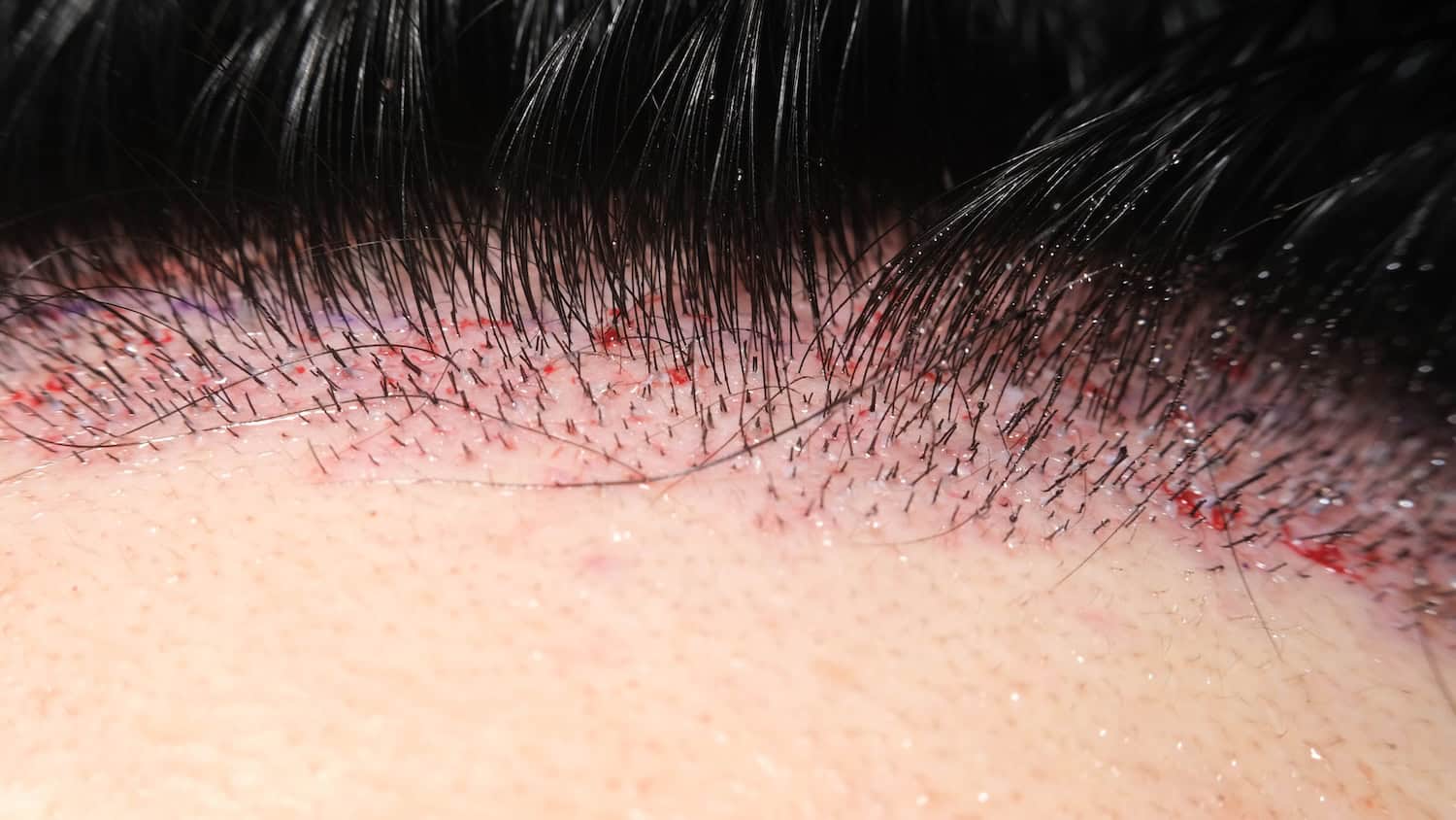 Close-up of DHI hair transplant with micrografts