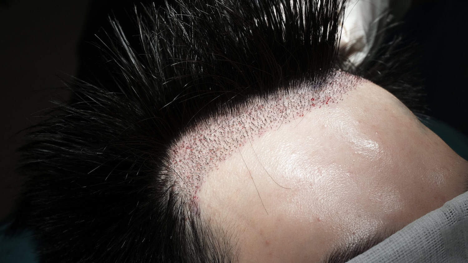 Front hairline result after a DHI transplant in Bangkok 