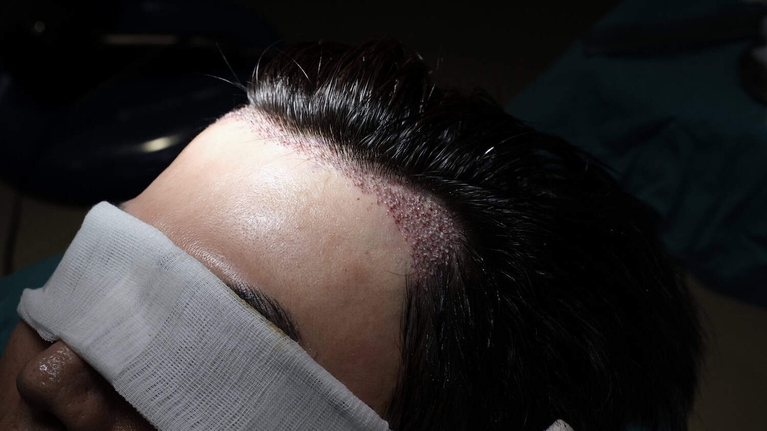 DHI micrograft hair transplant procedure in Thailand